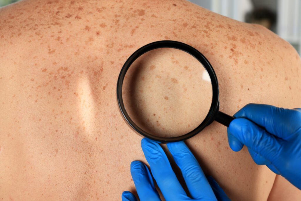 Dermatologist examining sun spots on back with a magnifying glass